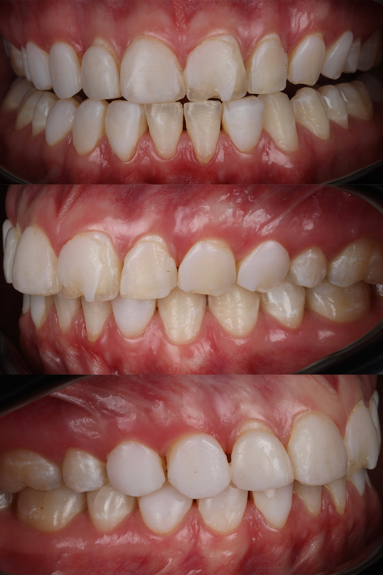 Intraoral photos before treatment