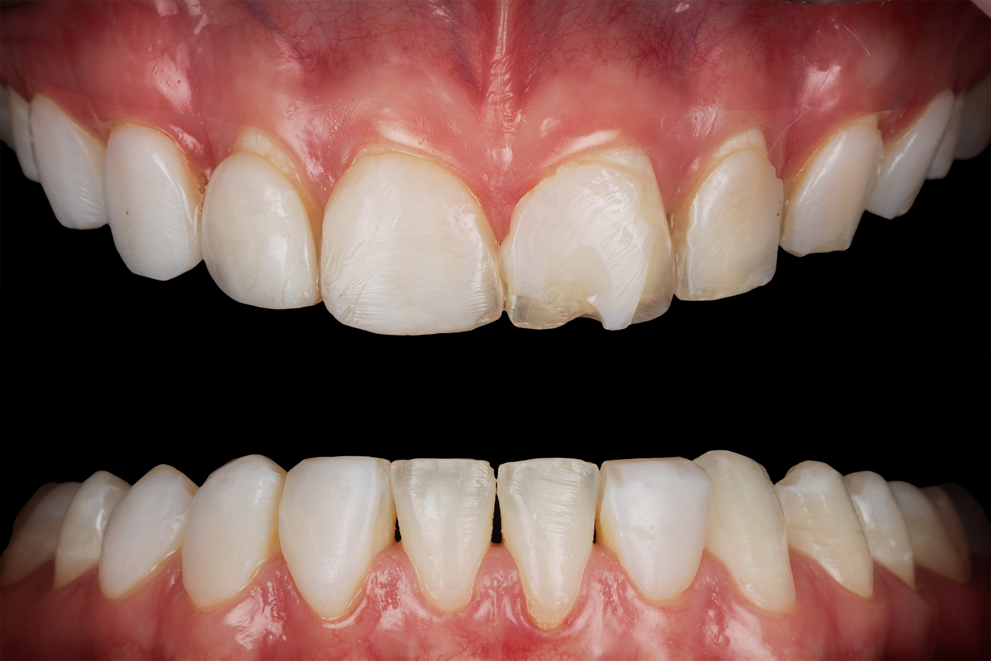 Intraoral photos before treatment