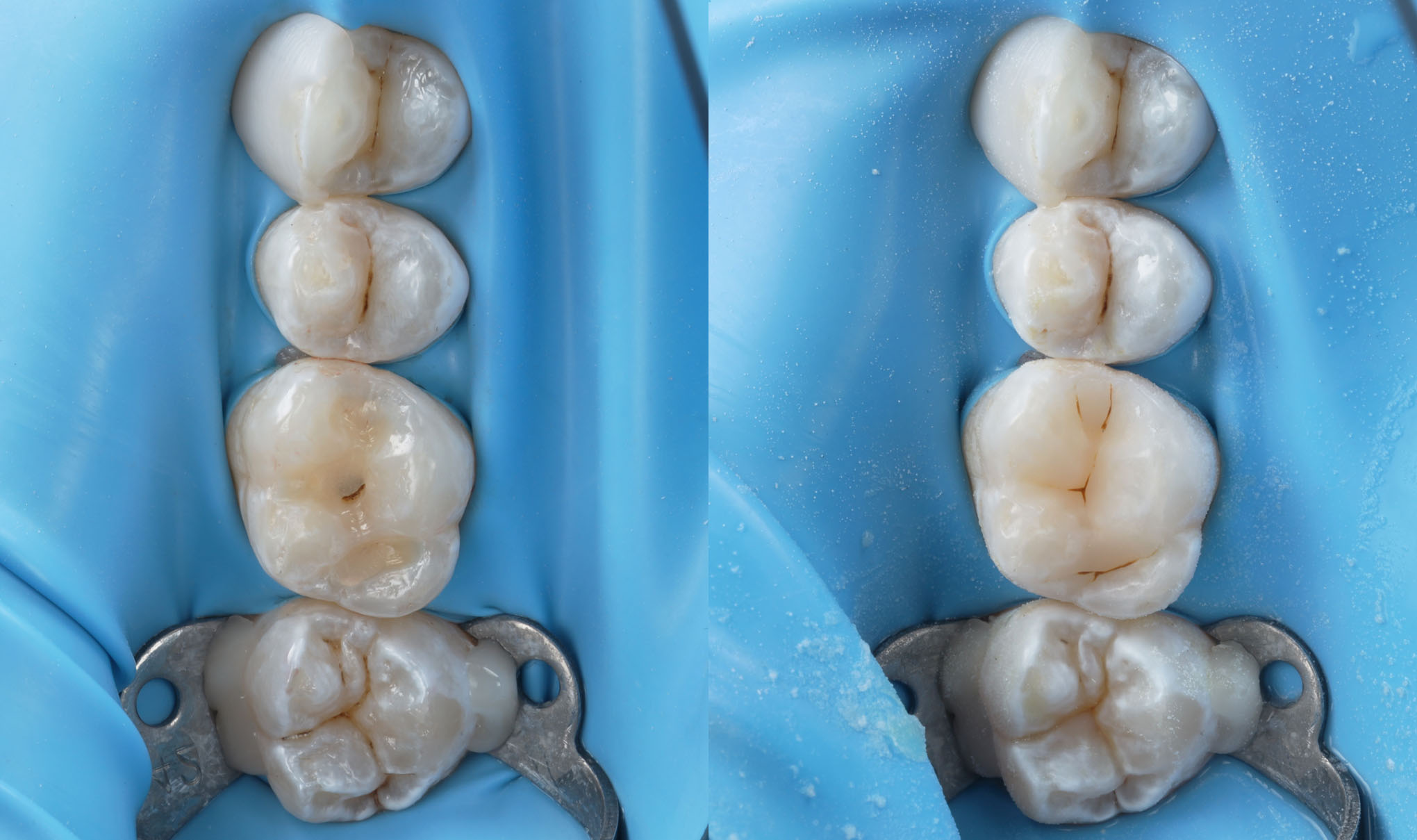Direct composite restoration of teeth 