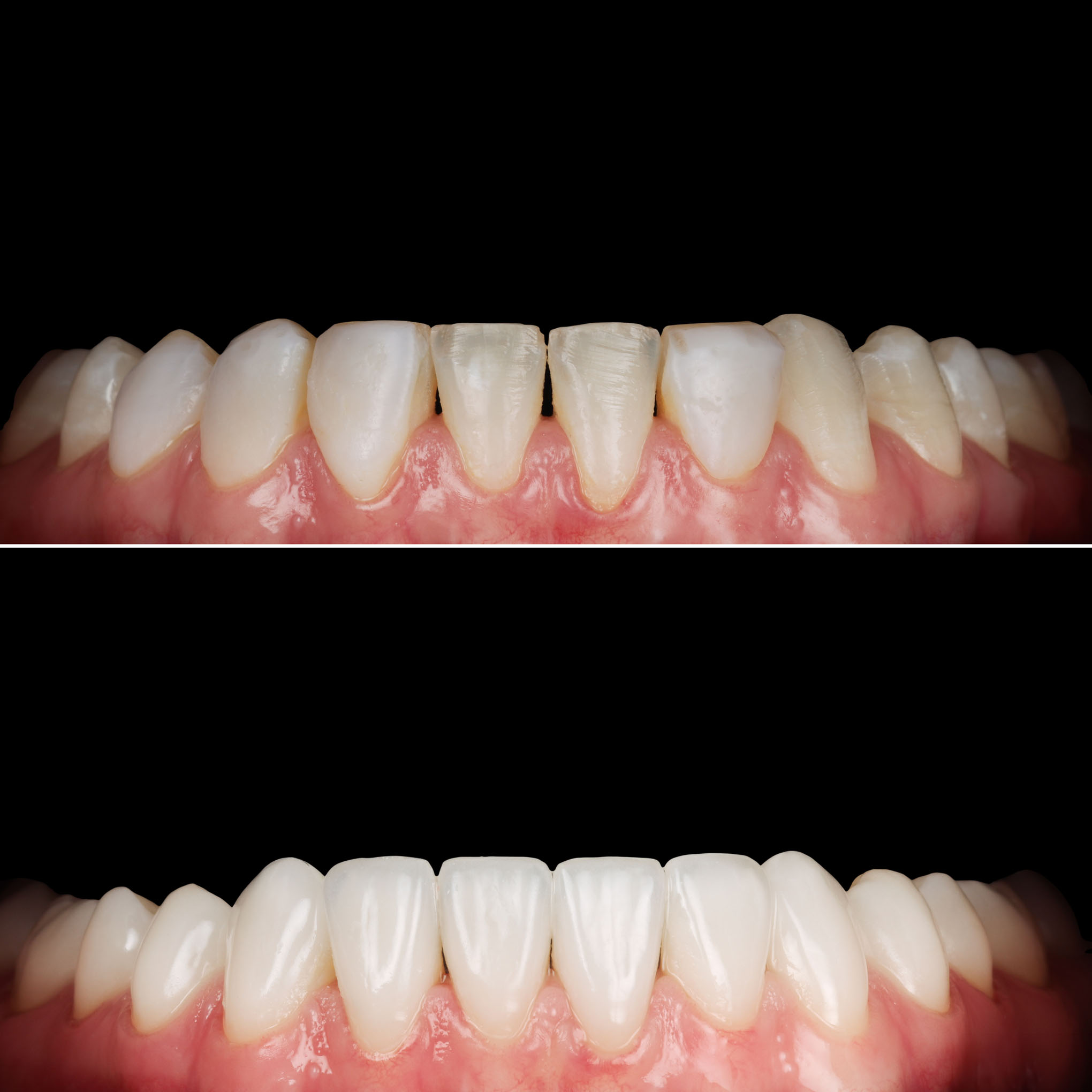 Mandibular teeth before and after treatment