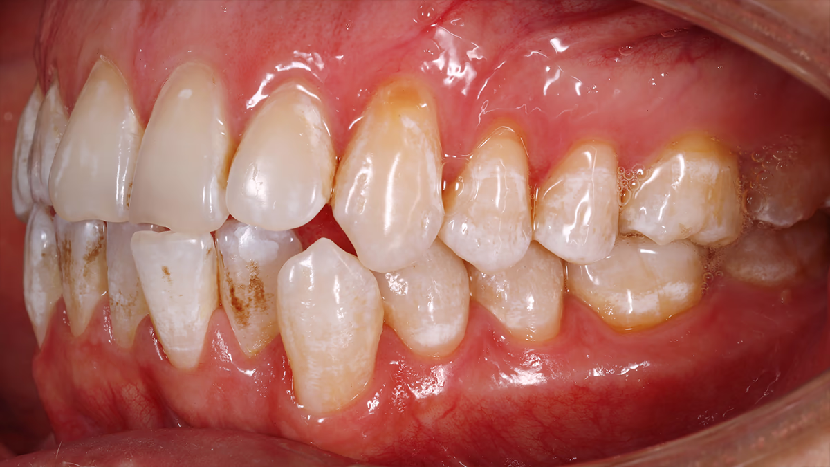 Вигляд зубного ряду збоку справа до лікування — нерівні зуби, плями на емалі