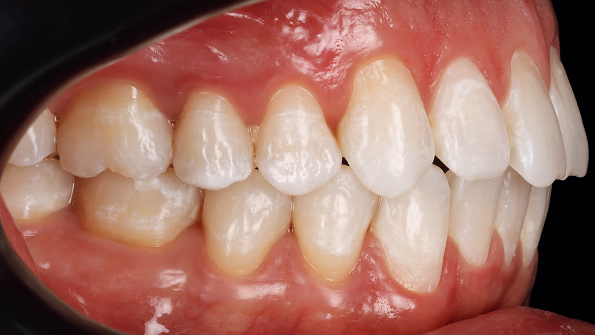 Вигляд зубного ряду збоку зліва після лікування — вирівняні зуби, чиста емаль