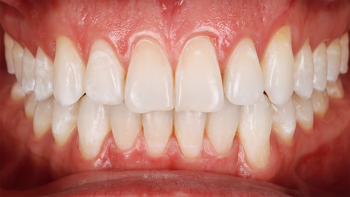 Фронтальний вигляд зубів після лікування — рівні зуби з однорідним кольором емалі