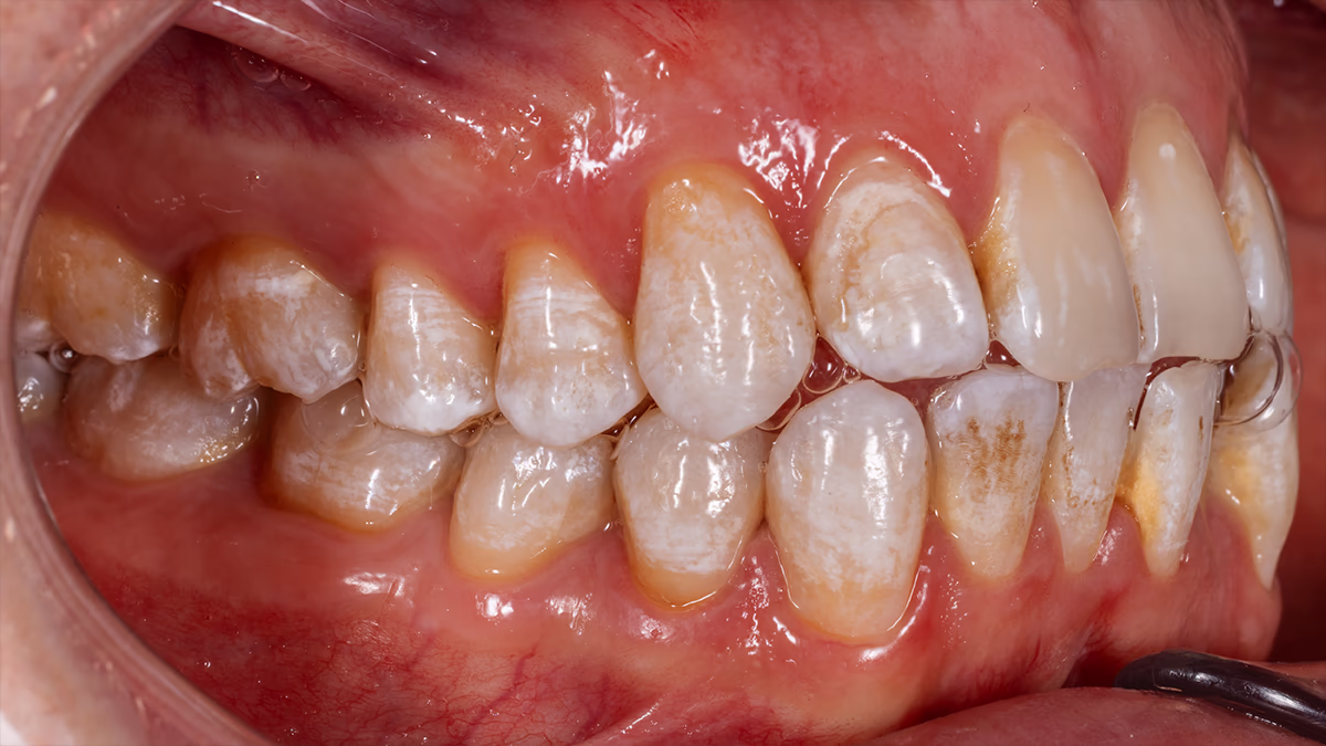 Вигляд зубного ряду збоку зліва до лікування — нерівні зуби, плями на емалі