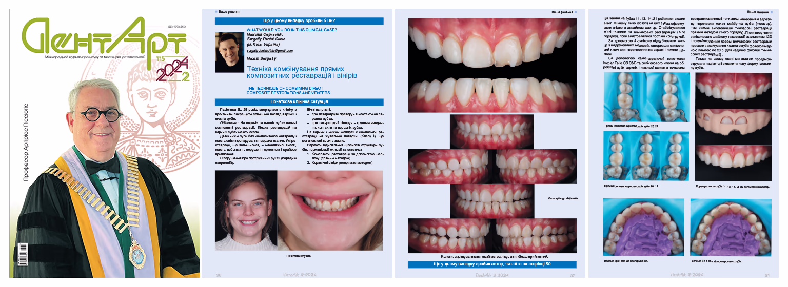 Сторінка журналу ДентАрт з публікацією про техніку комбінування прямих композитних реставрацій і вінірів