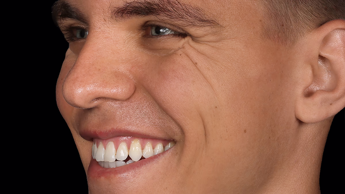 Обличчя пацієнта після лікування, рівна посмішка та покращений профіль