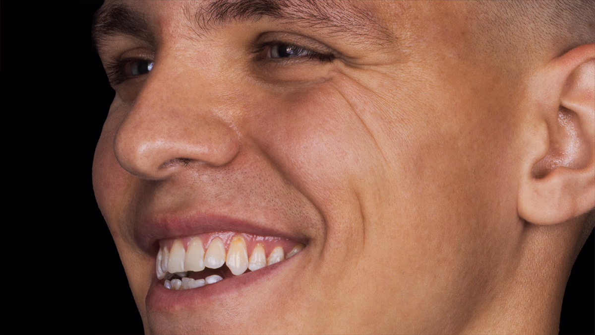 Обличчя пацієнта до початку лікування, вид збоку