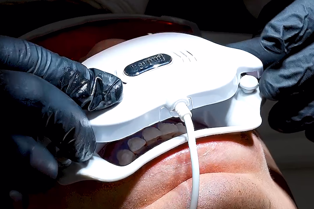 Процедура відбілювання зубів після зняття брекетів у клініці Sergatiy Dental Clinic