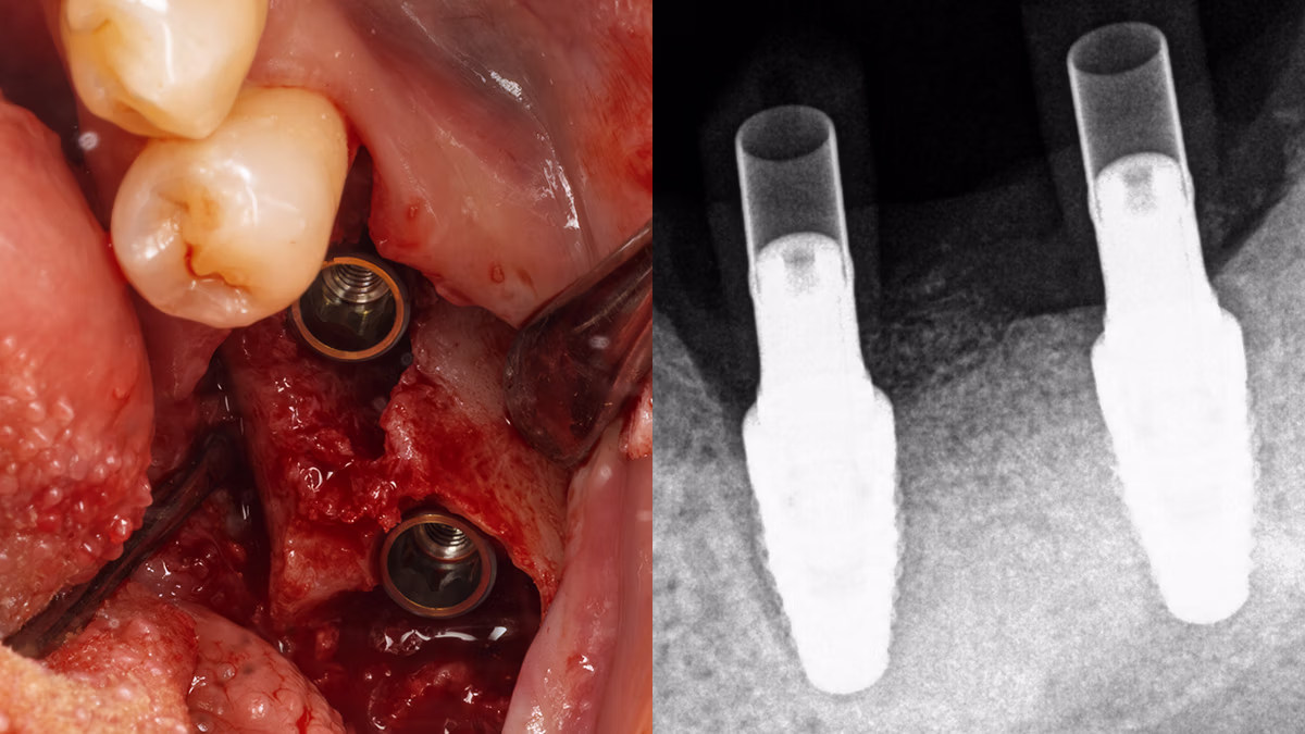 Два дентальних імплантати в щелепі під час хірургічної процедури та їх рентгенівське зображення.