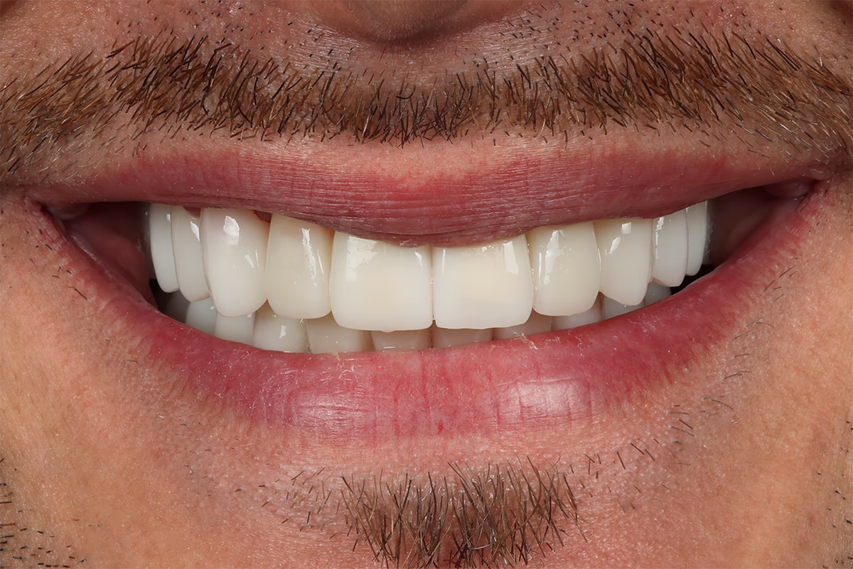 Посмішка з білими зубами і світлою вусами на верхній губі.