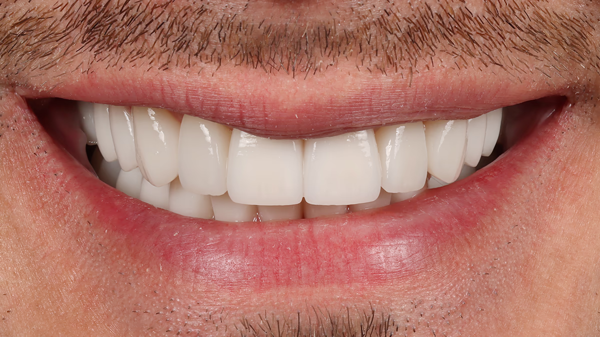 Посмішка чоловіка з білими ровними зубами та легким вусом і бородою.