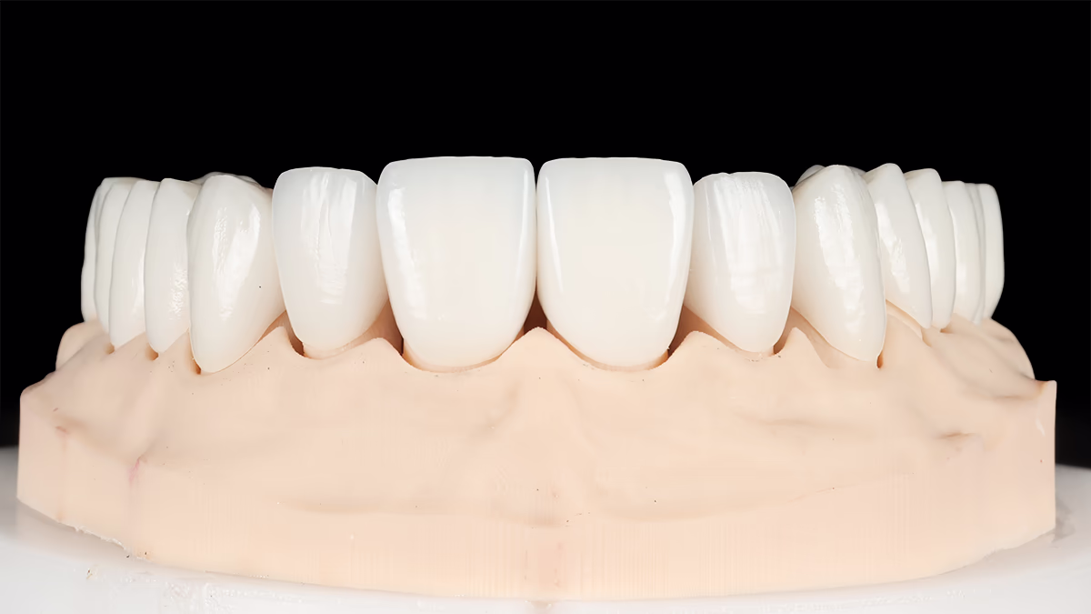 Модель верхнього ряду білосніжних зубних вінірів на стоматологічному гіпсовому відбитку.