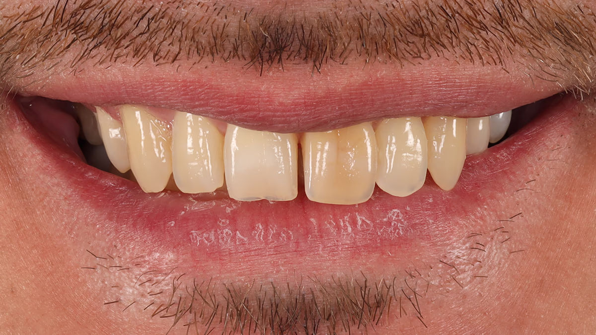 Посмішка чоловіка з видимими жовтуватими передніми зубами і невеликою бородою та вусами.