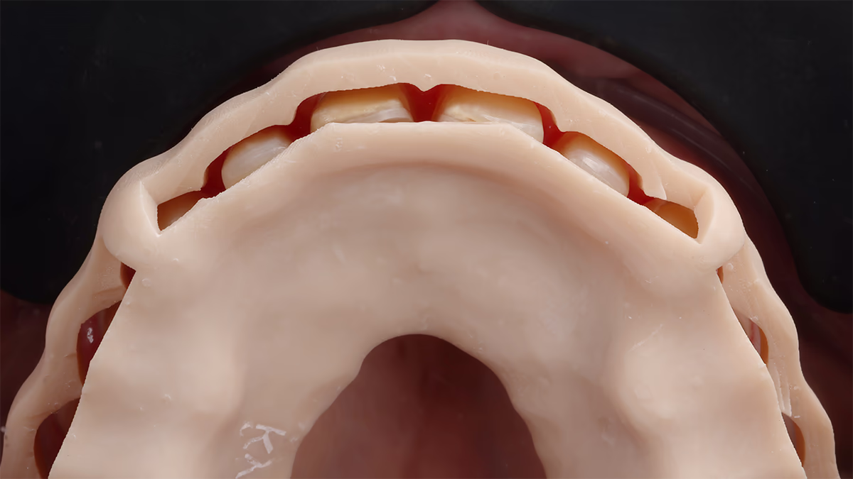 Верхній зліпок зубів із воску, що демонструє положення зубів.