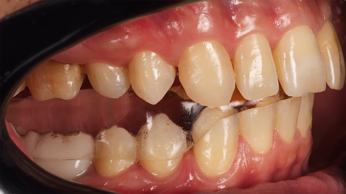 Бічний план зубів з прозорою елайнерною капою на нижньому ряду зубів.