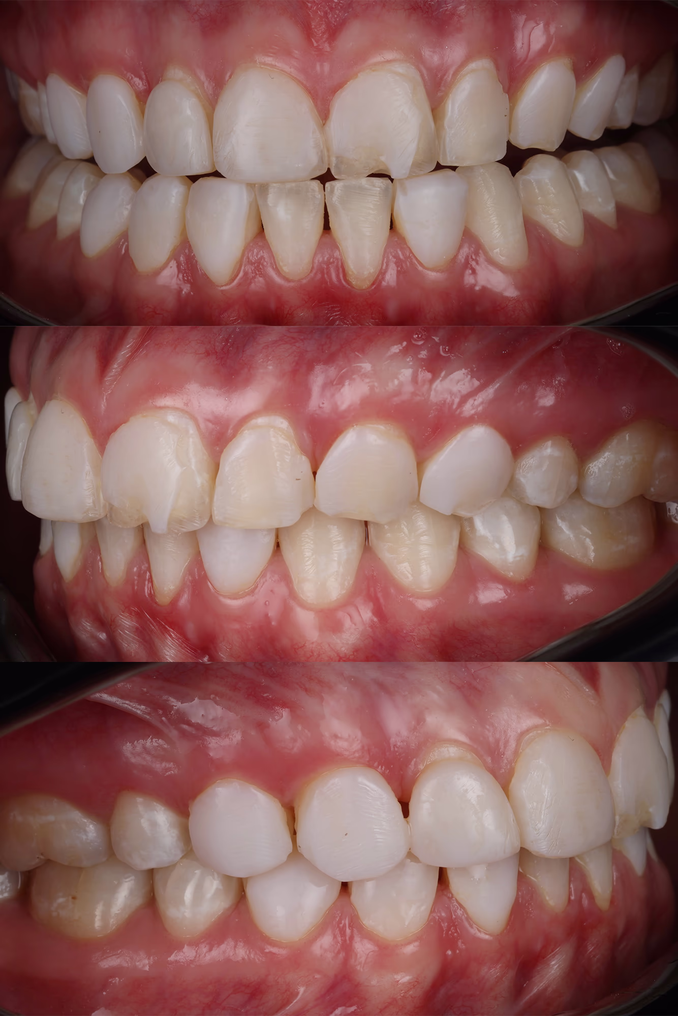 Фото зубів до лікування, вид спереду та з боків, видно сколи та зношення передніх зубів.