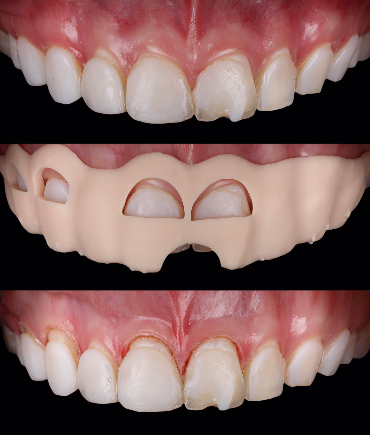 Фото зубів під час лікування, ізольовані кофердамом для прямої реставрації.