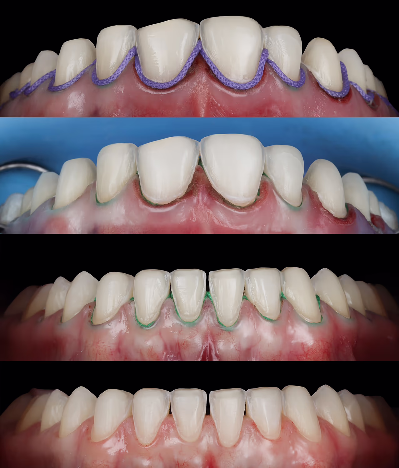 Ретракція ясен перед етапом фіксації вінірів, підготовка до цементування.