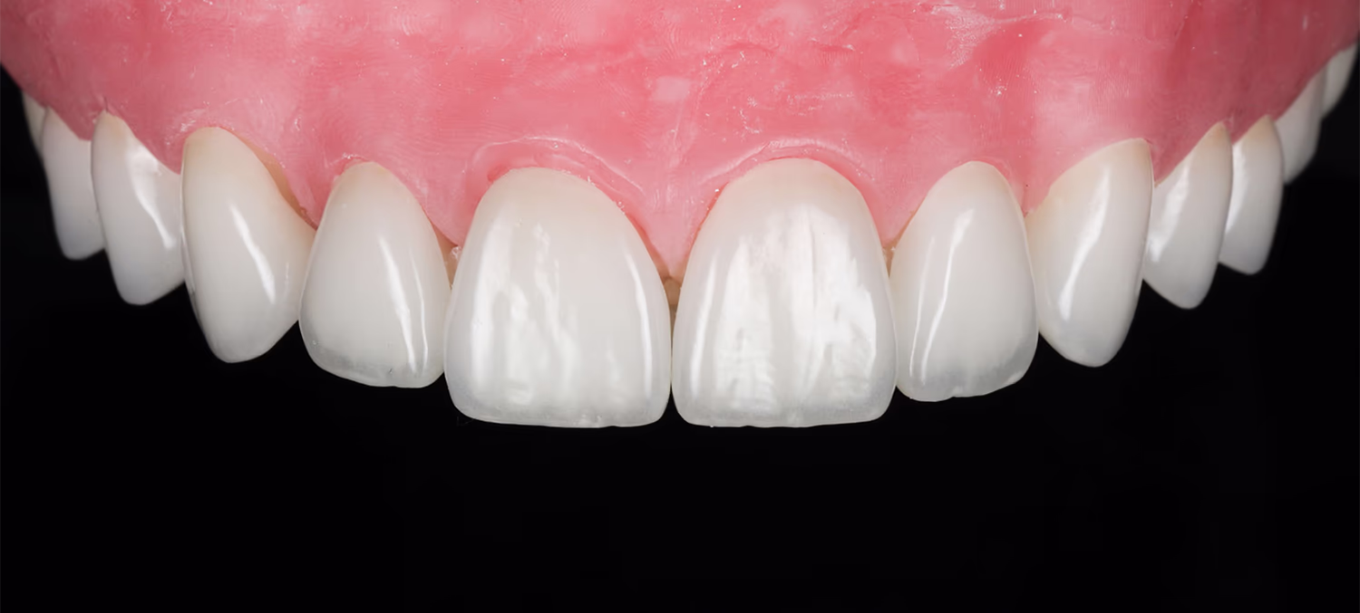 Керамічні вініри перед фіксацією, вид з оклюзійного ракурсу.