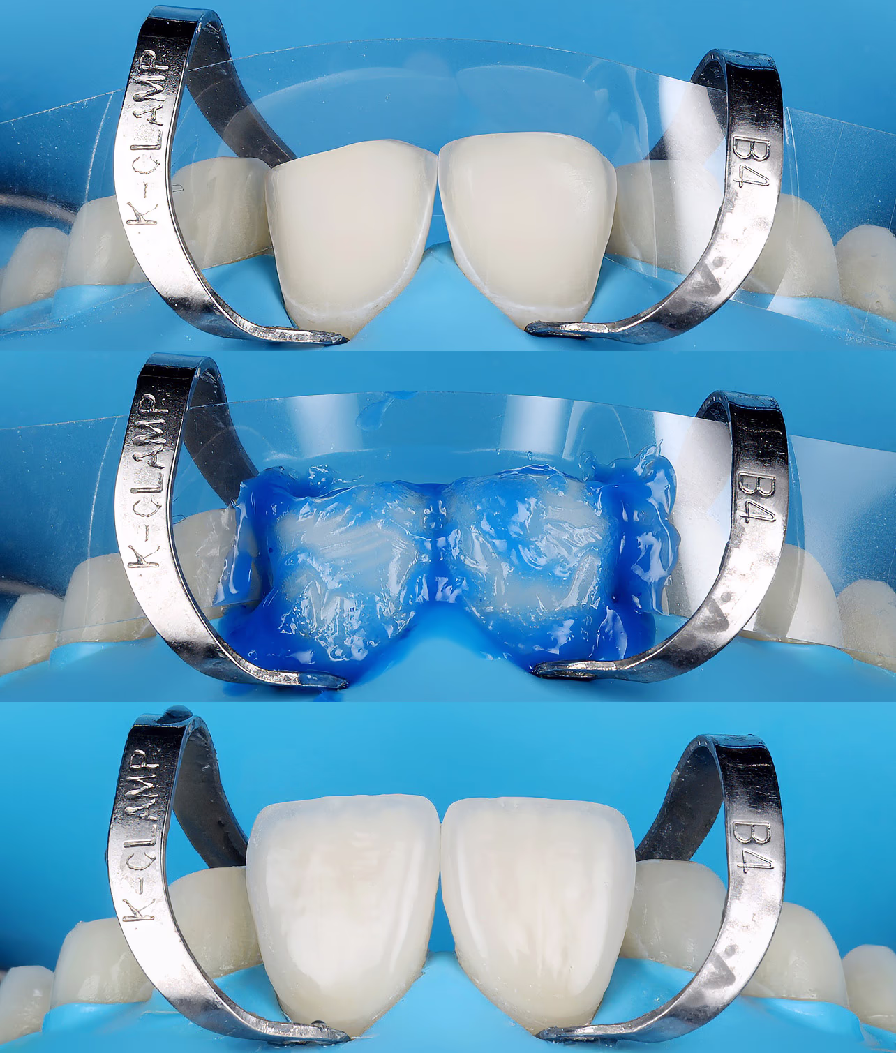 Фіксація керамічних вінірів на фронтальних зубах, завершальний етап лікування.