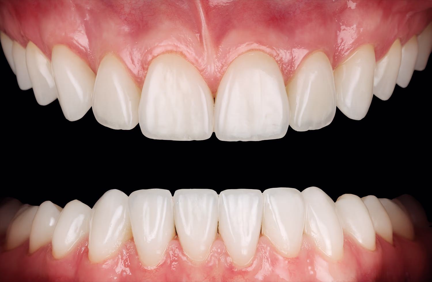 Білоі посмішки з рівними передніми зубами і здоровими яснами на чорному тлі.
