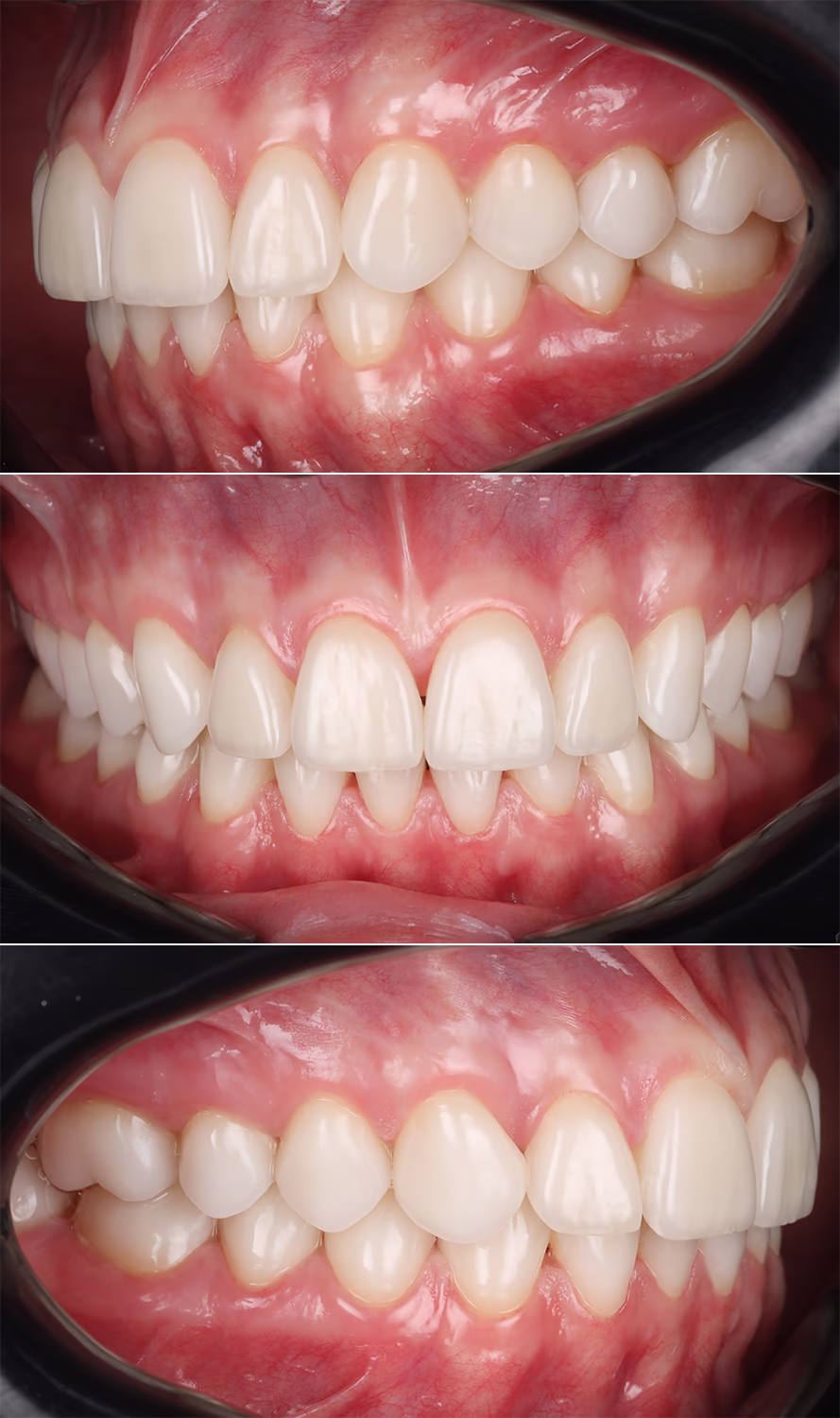 Три знімки, що демонструють інтрональність передніх і бічних зубів