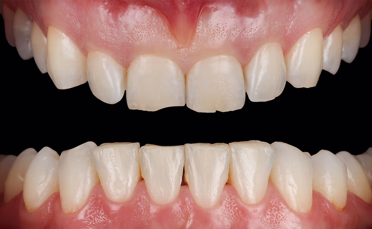 Демонстрація результату ортодонтичного лікування обох щелеп