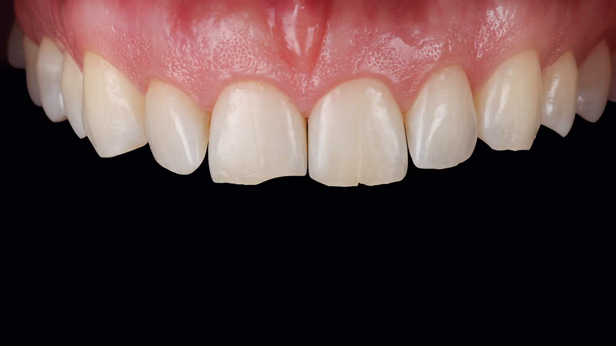 Демонстрація стану ясен через 4 тижня після корекції