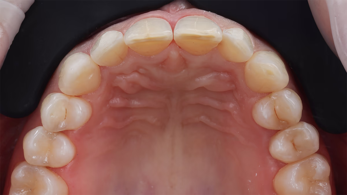 Пришліфовування зубів