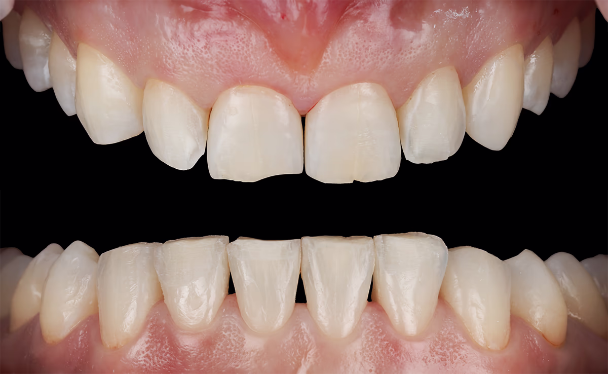 Пришліфовування зубів 12, 22, 41, 42, 32