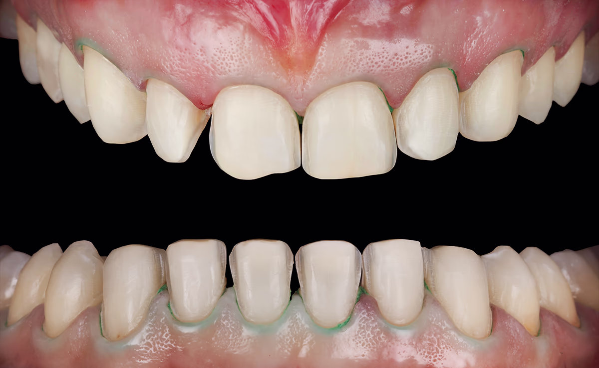 Фото Ретракції однією ниткою 000