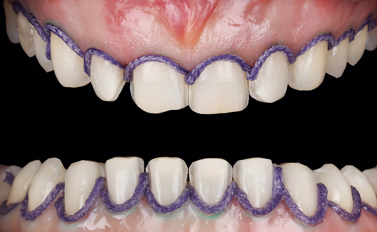 Фото зубів з процесом ретракція ниткою 0