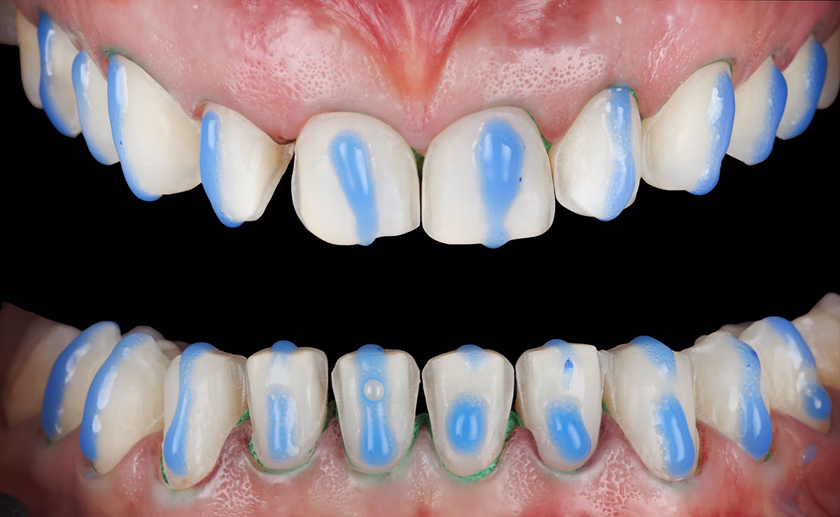 Протравлення емалі