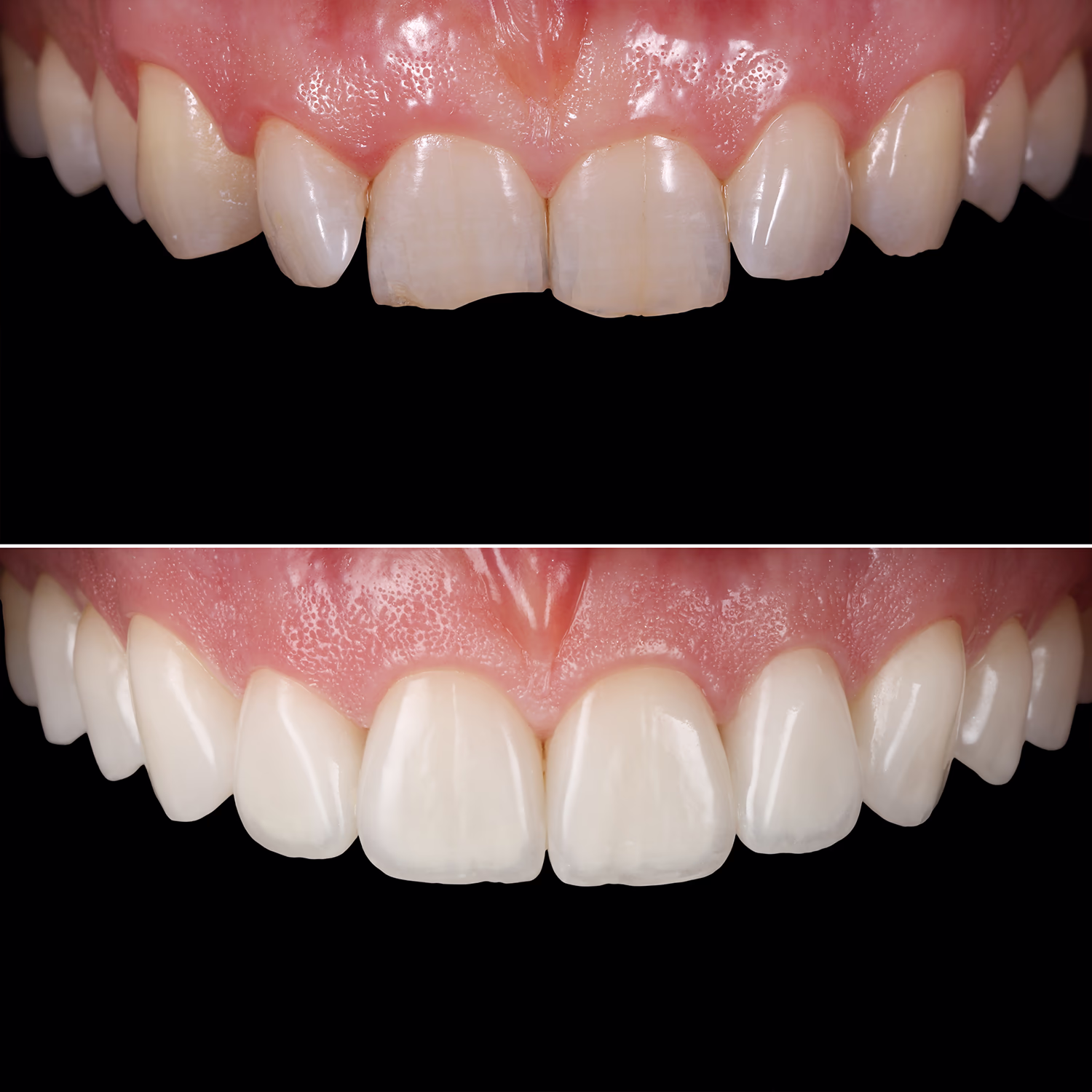 Фото до та після лікування верхньої щелепи