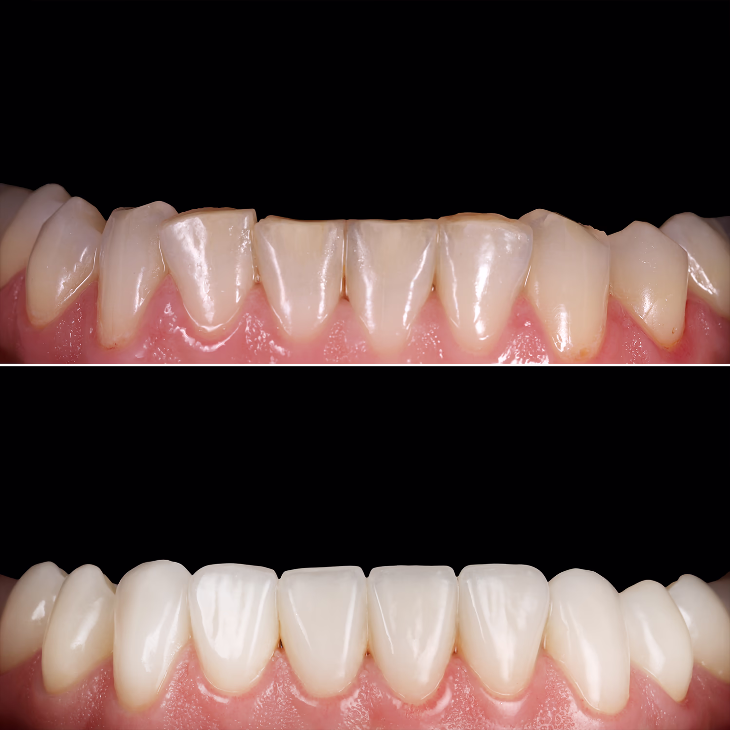 Фото до та після лікування нижньої щелепи