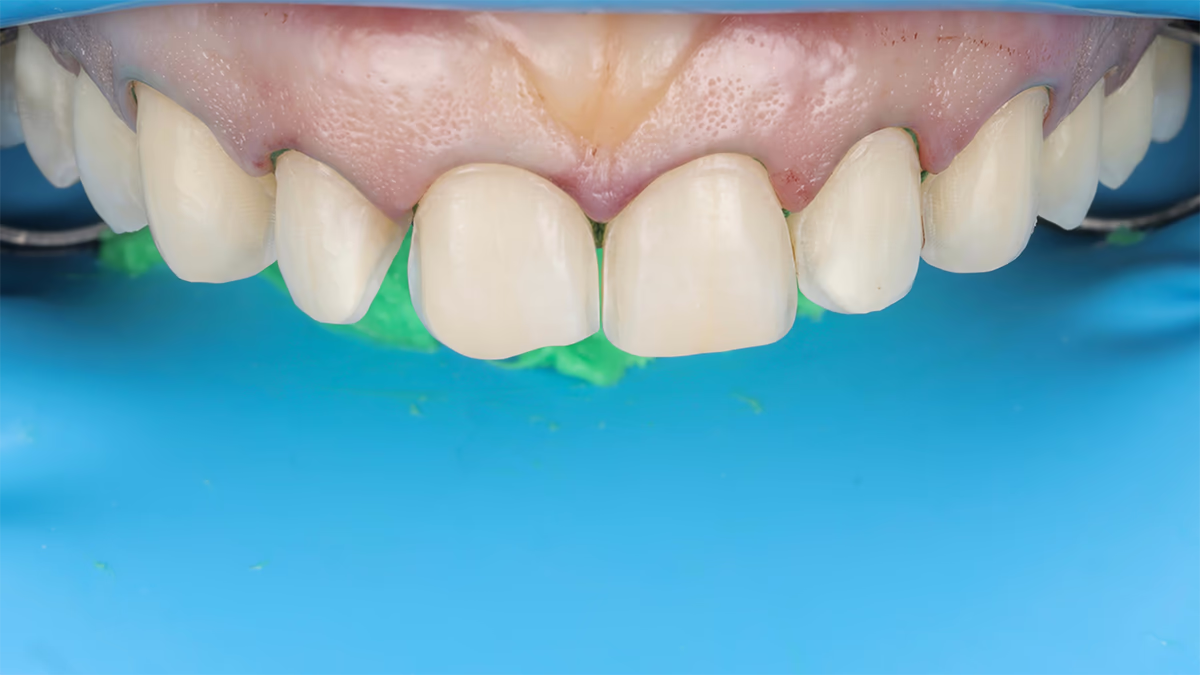 Вигляд зубів після зняття тимчасових вінірів