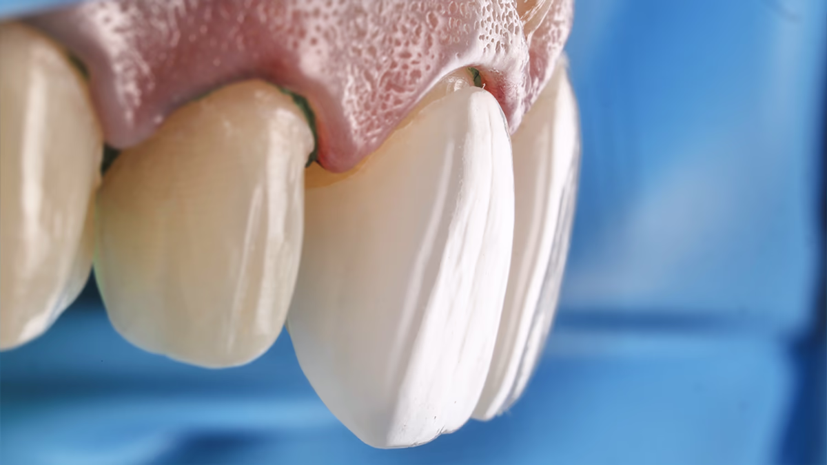 Примірка вінірів