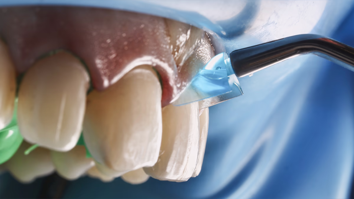 Повітряно-абразивна підготовка зубів для встановлення вінірів