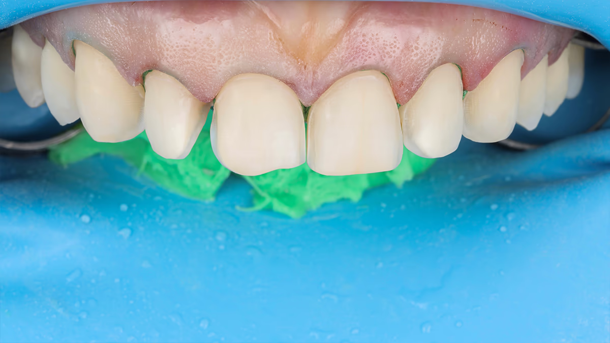 Вигляд зубів після повітряно-абразивної підготовки