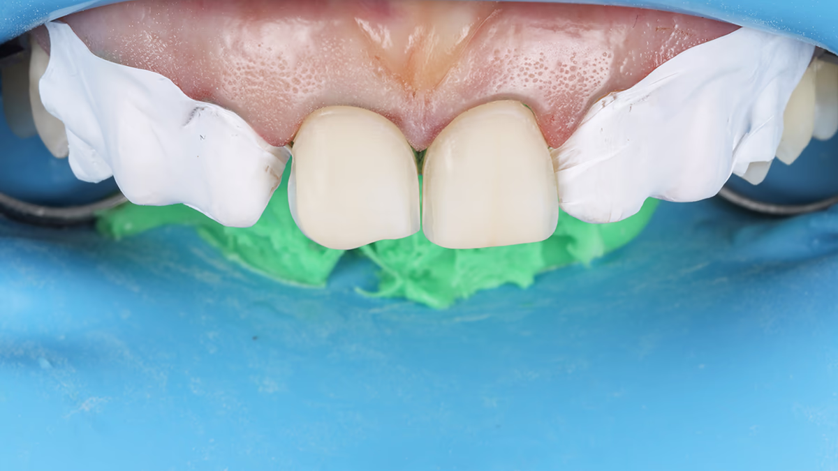 Захист сусідніх зубів тефлоном