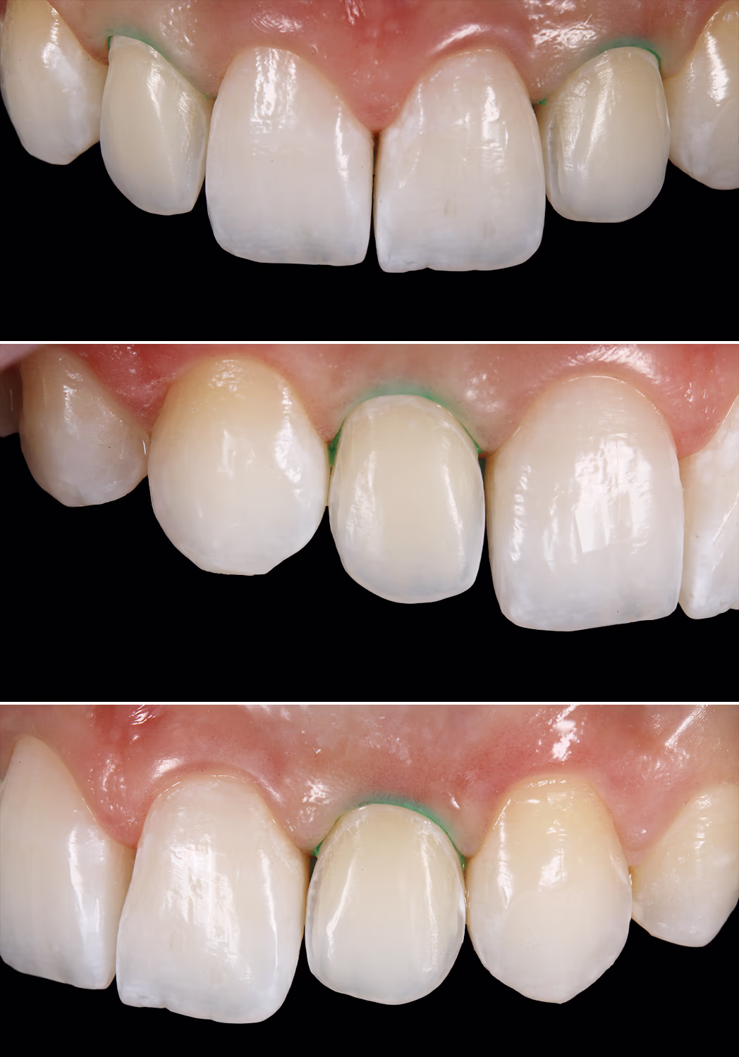 Три крупные фотографии с ретракцией десен перед снятием отпечатков под керамические виниры