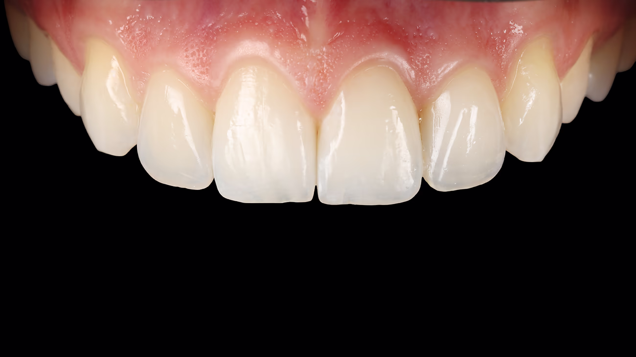 Финальный результат Блестящие белые передние зубы с розовыми деснами на черном фоне.