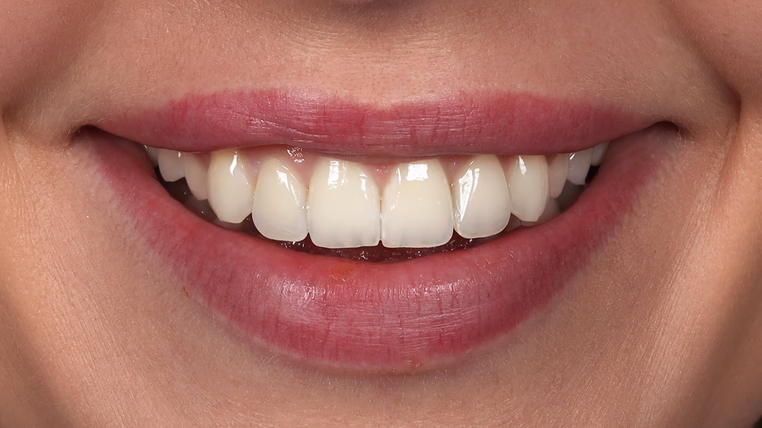 Улыбка с блестящими белыми зубами и розовыми губами после установки виниров.