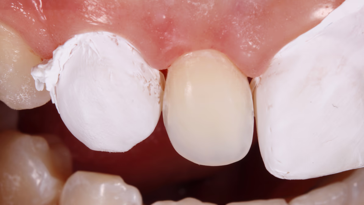 Ближний план зубов с защитой фум-лентой перед фиксацией виниров