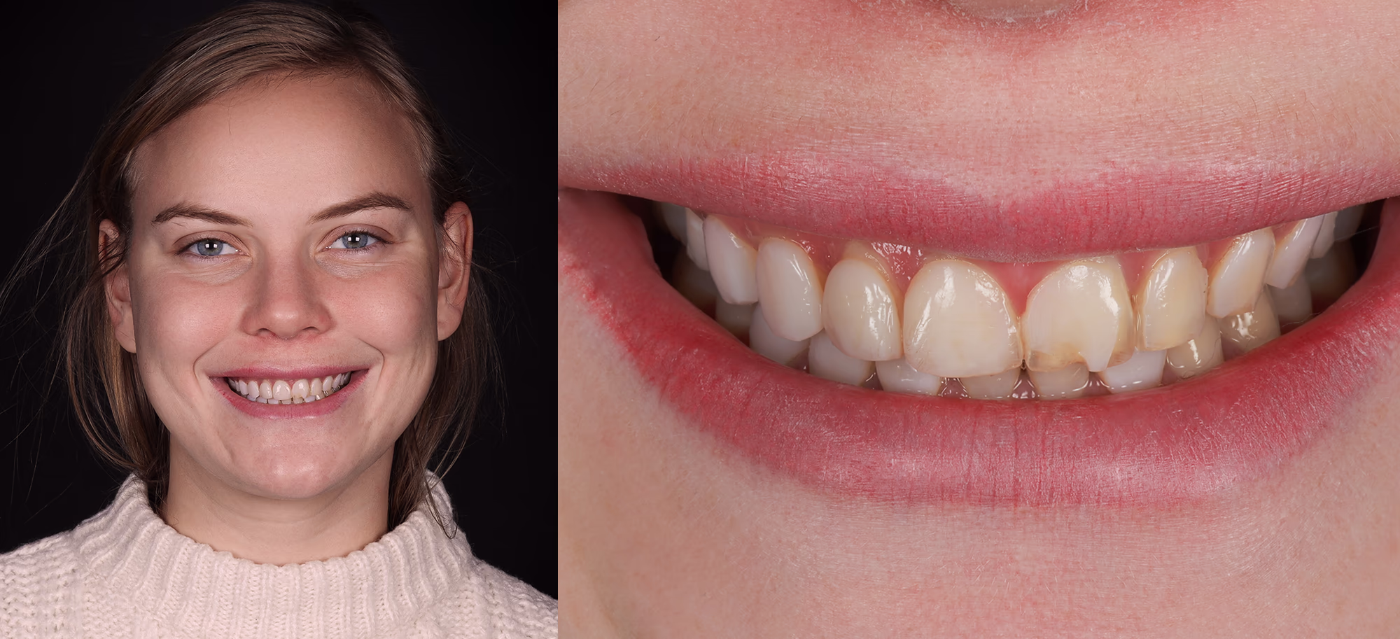 Портрет пацінтки та детальний план усмішки перед лікуванням, демонструє початковий стан зубів