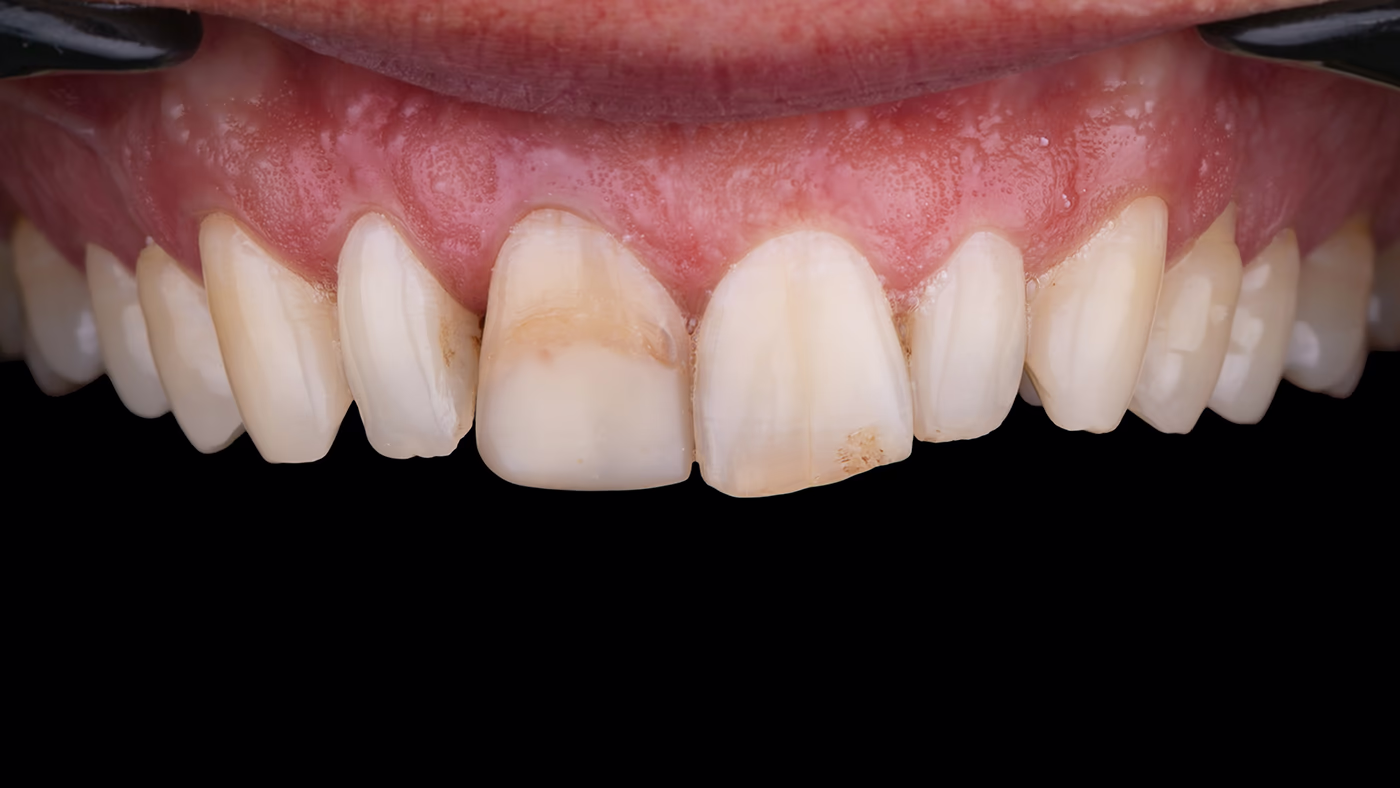 Фронтальний вигляд зубів із плямами та дисколоритом на двох центральних різцях, початкова ситуація.