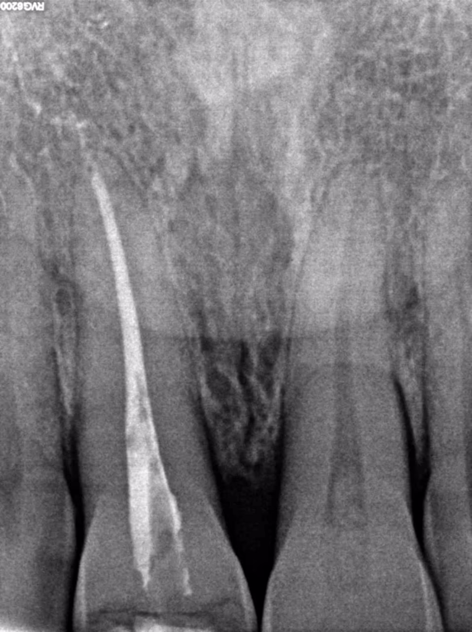 Прицільний рентгенівський знімок зубів у прикусі: один зуб має заповнений матеріалом кореневий канал.