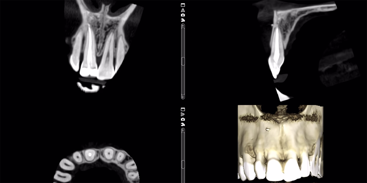 Комп'ютерна томографія зубів, показані перетини верхньої щелепи та 3D-модель передніх зубів.