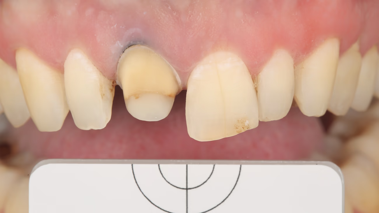 Ближнє фото верхніх зубів із відпрепарованим зубом без поляризаційного фільтра.