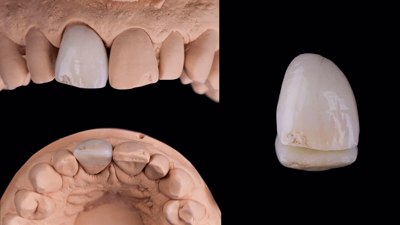 Три зображення стоматологічної моделі щелепи з встановленою керамічною коронкою на передньому зубі та окреме фото коронки на чорному тлі.